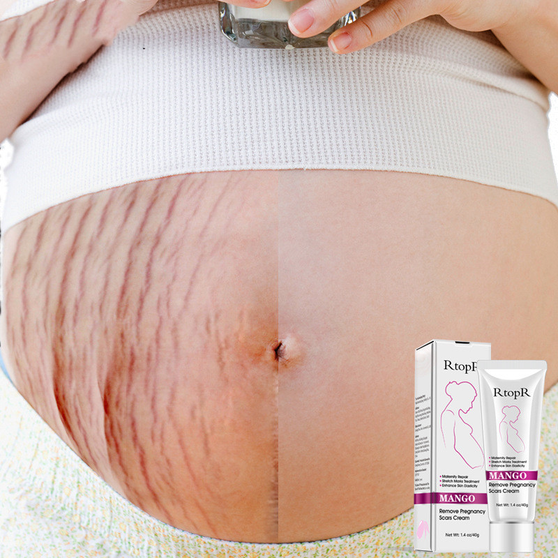 Mango Stretch Mark Prevention Cream